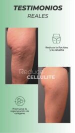 REDUCE CELLULITE - Image 3